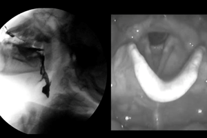 Evaluación instrumental para usuarios con trastornos de la deglución